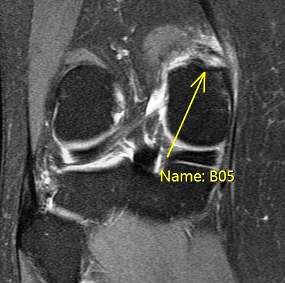 Figure 6 for case Partial tear of the tendon of the medial head of the gastrocnemius muscle ( RID2921 )